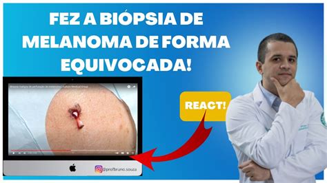 Entenda Como Realizar Uma Bi Psia De Melanoma C Ncer De Pele Youtube