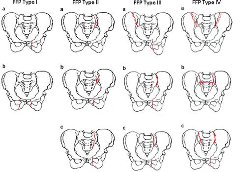 Pelvis Types