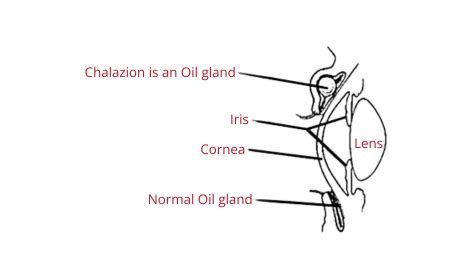 Chalazion Surgery: Symptoms, Causes, Treatment & After-care.