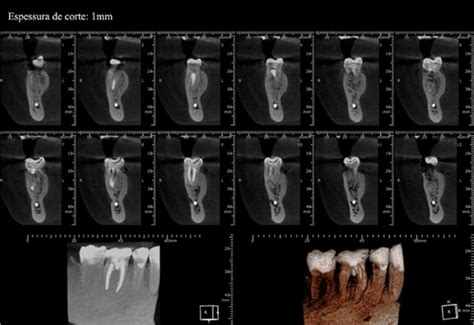 Cone Beam Computed Tomography Images And Periapical Radiography After Download Scientific