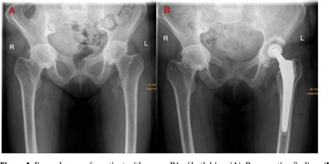 Figure From The Direct Anterior Approach Daa As A Standard Approach