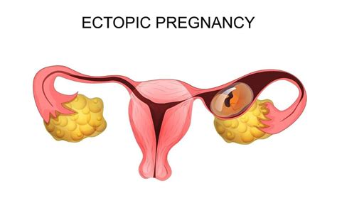 Ectopic Pregnancy Detection And Treatment Laparoscopic Versus Medical