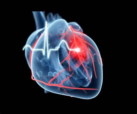 Estudio Revela Formas De Miocarditis Fulminante Derivadas Del Covid 19