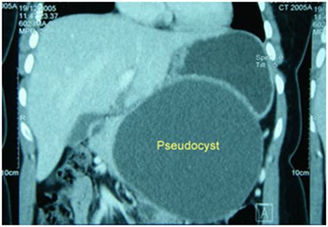 Pseudo Pancreatic Cyst Treatment,Pseudo Pancreatic Cyst India