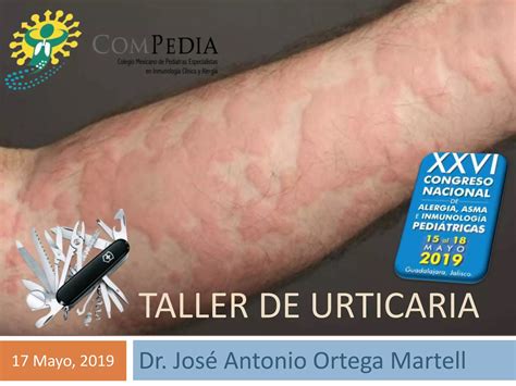 Taller De Urticaria Prof Ortega Martell Ppt