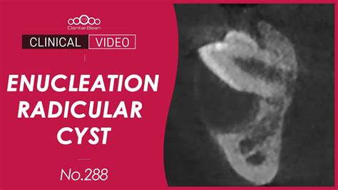 Enucleation Of Radicular Cyst Dr Cho Yongseok Youtube