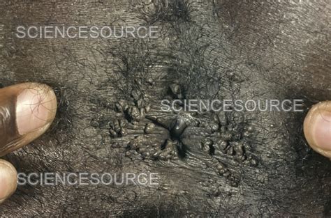 Venereal Anal Warts Of A Male AIDS Pat Stock Image Science Source Images