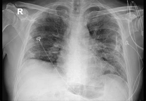 Chest X Ray Showing Bilateral Interstitial Infiltrates With