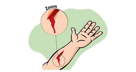 First aid for cuts and bleeding | TheHealthSite.com