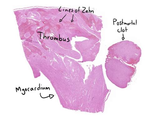 19 Thrombus And Postmortem Blood Clot Flashcards Quizlet