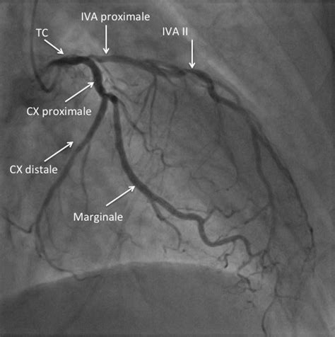 Les Incidences Radiologiques Cardio Paramed Cardio Paramed