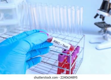 Rbc Test Look Abnormalities Blood Blood Stock Photo 2240634895 ...