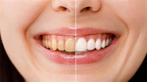 Ideias Naturais Para Remover O T Rtaro Dos Dentes Em Casa