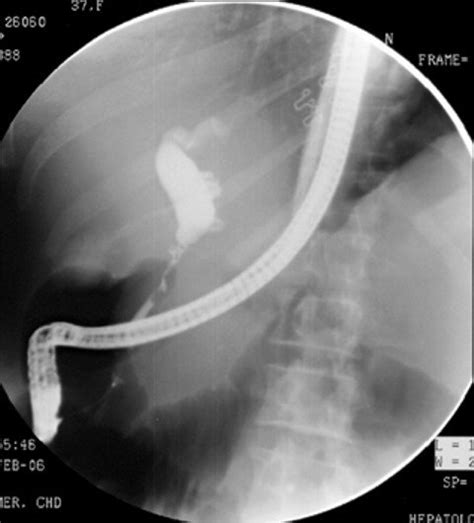 Endoscopic Retrograde Cholangiogram Showing Narrowing At The Lower End