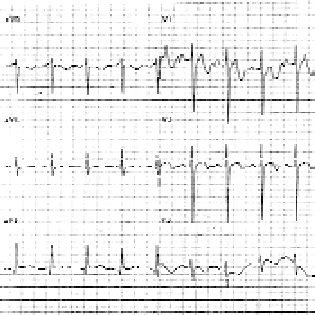 Admission Electrocardiogram Shows Sinus Rhythm With Normal Amplitudes