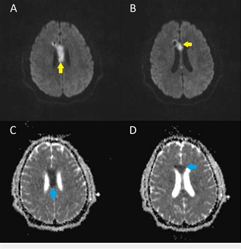 Infarction of the corpus callosum MRI showing areas of hyperintensity ...