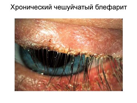 Воспалительные заболевания глаз и вспомогательного аппарата ...