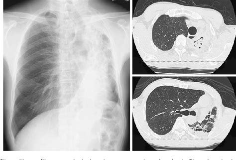 Figure 1 From Diffuse Alveolar Hemorrhage Following Itraconazole