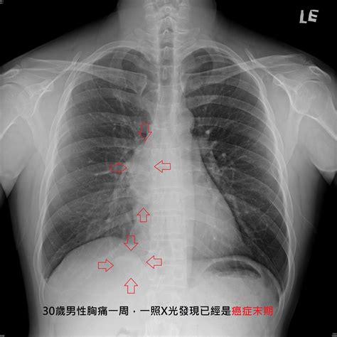 胸腔重症蘇一峰醫師 2月 2019