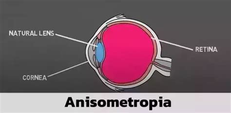 Anisometropia: An Overview – EYExan.com