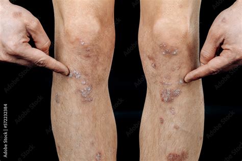 Stockfoto Eczema On The Legs Atopic Dermatitis Close Up Allergic