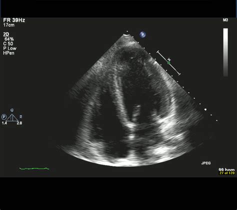 Echocardiogram Heart Failure