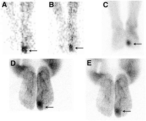 Example Images Of Osteomyelitis Arrows Significant Uptake Of 99m