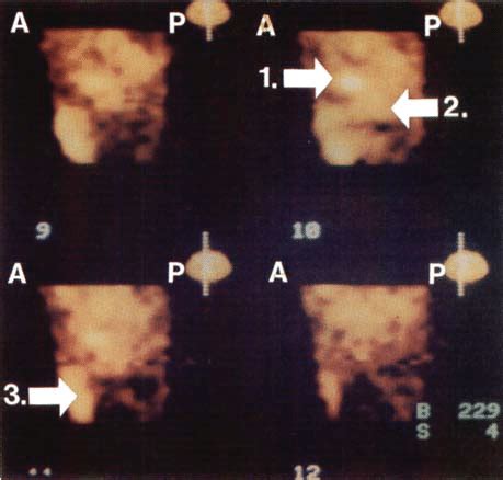 SPET Scan 72 H After Injection Of In PAP MoAb 185 MBq And Unlabeled