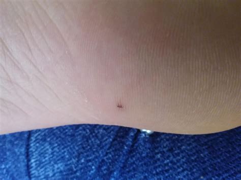 I Have A Glass Shard In My Foot I Do Not Know If It Is Infected And I Have Been Limping For The