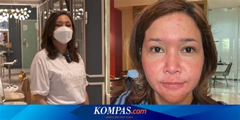 Maia Estianty Alami Penyakit Rosacea Penyakit Apa Itu