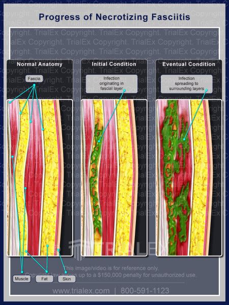 Progress Of Necrotizing Fasciitis TrialExhibits Inc