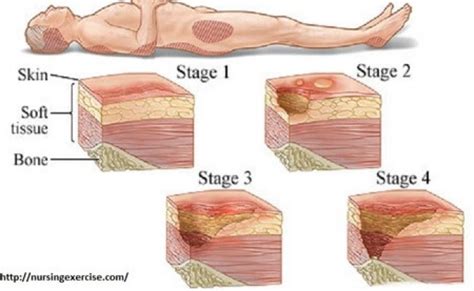 4 Stages Of Bedsore Pressure Sores Complications – Otosection