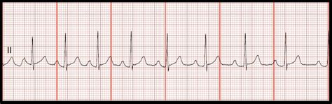 Float Nurse Practice Ekg Rhythm Strips 124