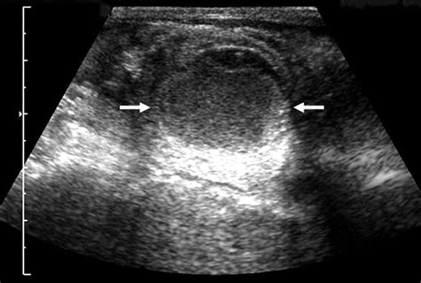 Simultaneous Presentation Of Congenital Neuroblastoma In Monozygotic