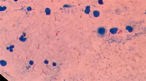 Acid Fast Staining Mycobacterium Tuberculosis