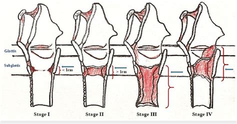 McCaffrey Classification Of Development Of Subglottic Stenosis Green