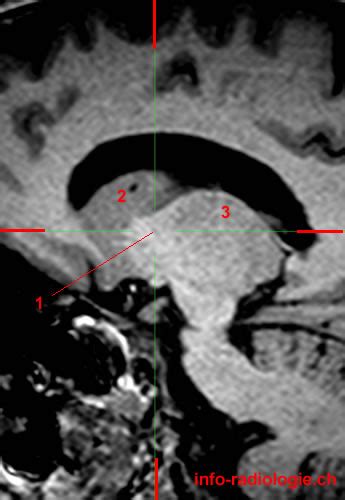 Internal capsule - W-Radiology