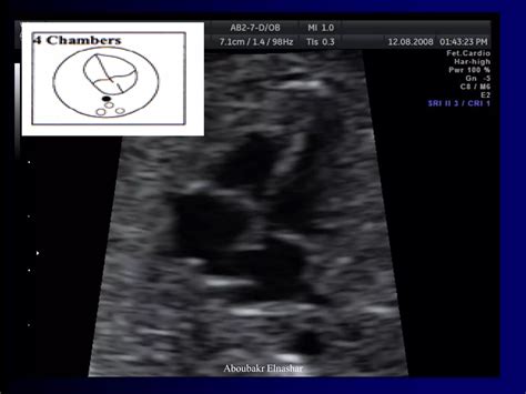 Ultrasonography Of Congenital Fetal Defects Ppt