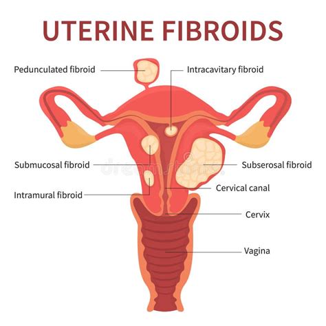 Uterine Fibroids Stock Illustrations Uterine Fibroids Stock