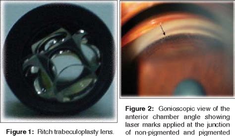 Figure 1 From Argon Laser Trabeculoplasty As Primary Therapy In Open