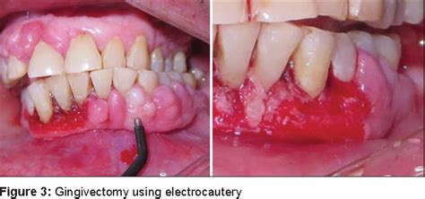 Figure From Comparison Between Laser Electrocautery And Scalpel In