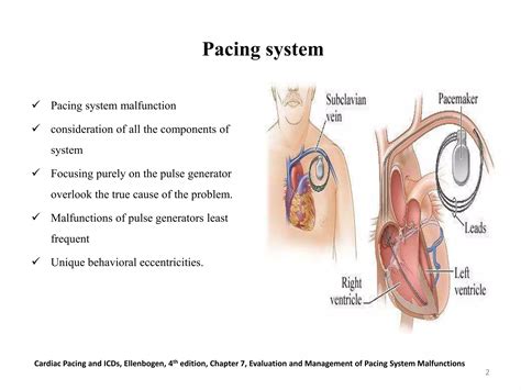 Evaluation And Management Of Pacemaker Malfunction Ppt