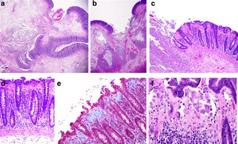 Microscopy Of The Resected Colon A And B Low Power Views 12 5 Of