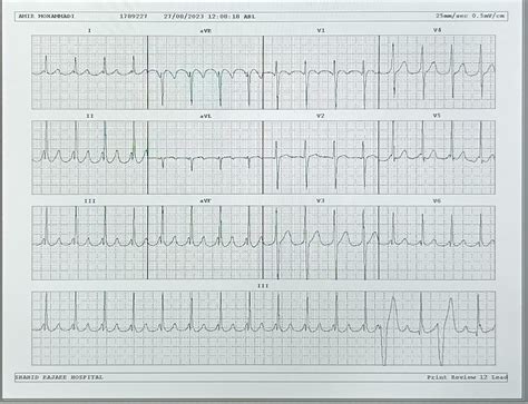 The Image Depicts The 12‐lead Electrocardiogram Tachycardia The Download Scientific Diagram