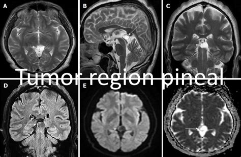 Otras Lesiones Cerebrales Neuro Recovery