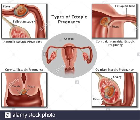 Embarazo Ectópico Cervical Fotografías E Imágenes De Alta Resolución