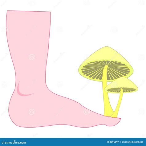 Athlete's foot stock illustration. Image of parasitic - 4896697