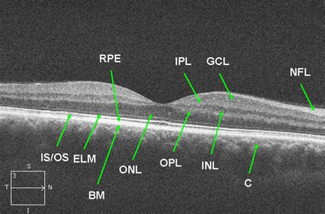 Normal Retinal Anatomy - The Retina Reference