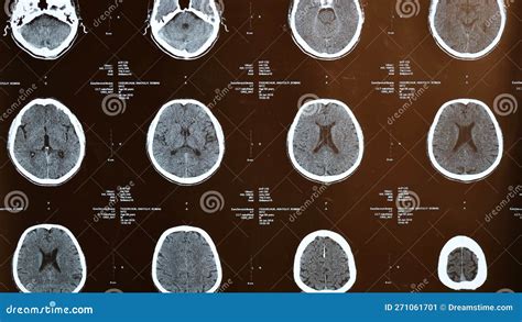 Risonanza Magnetica Del Cervello In Un Uomo Anziano Fotografia