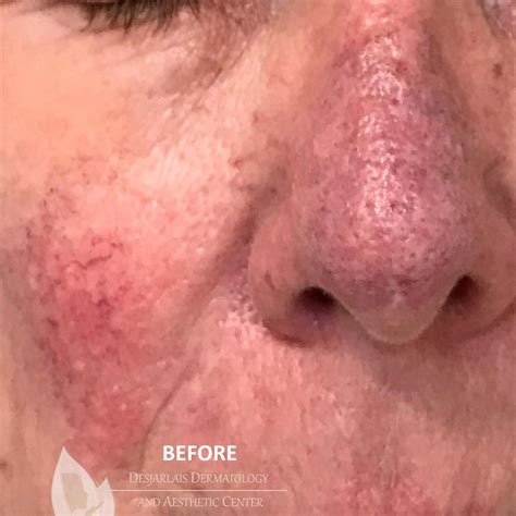 Before And After Gallery Dr Desjarlais Dermatology Adrian Mi